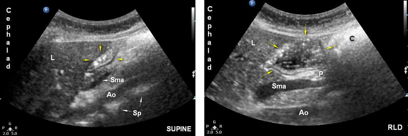 Légende: Ao: aorte A: antre; C: côlon; L: foie (liver); P: pancréas; Sma: artère mésentérique supérieure; flèches jaunes: antre