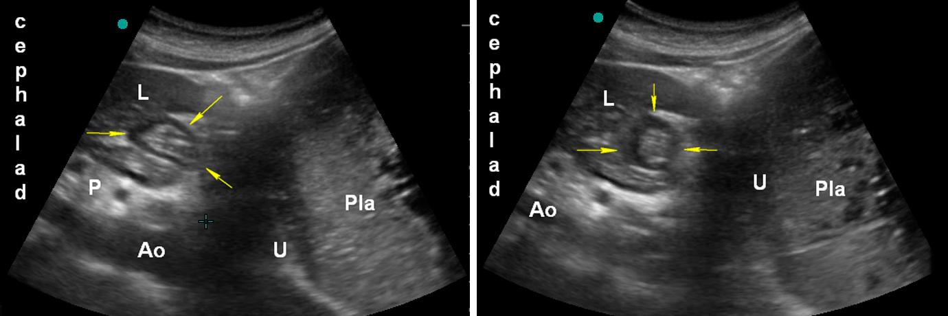 Légende: Ao: aorte; F: fœtus; L: foie (liver); P: pancréas; Pla: placenta; U: paroi utérine; flèches jaunes: antre vide.