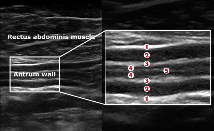 1: serosa; 2: muscularis propriae; 3: submucosa; 4: muscularis mucosa; 5: mucusal air interface