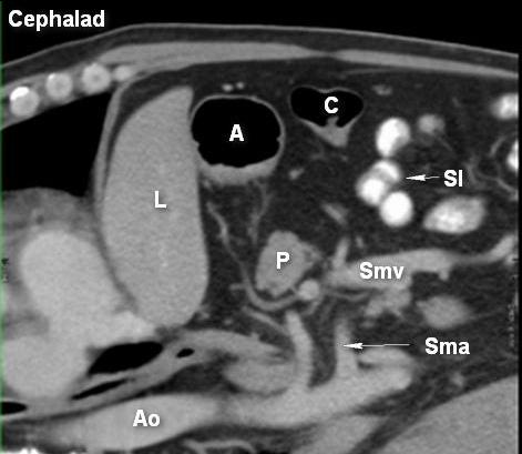 A: antre; Ao: aorte; C: côlon; L: foie (liver); P: pancréas; SI: intestin grêle; Sma: artère mésentérique supérieure; Smv: veine mésentérique supérieure; Sp: colonne vertébrale