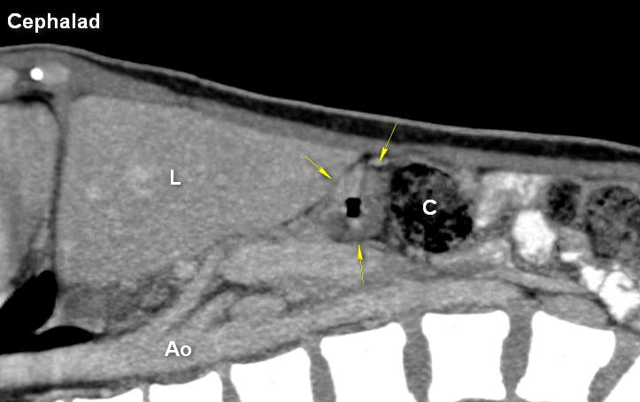 Ao: aorta; C: colon; L: liver; yellow arrows: prominent wall of antrum.