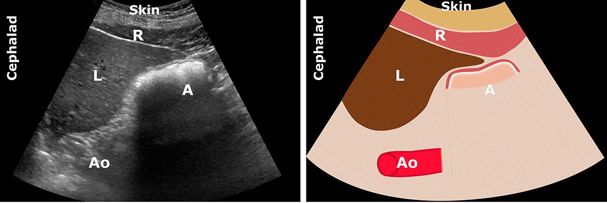 A: antre; Ao: aorte; L: foie (liver); R: muscle grand droit