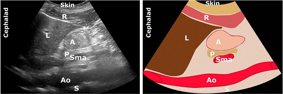 A: antre; Ao: aorte; L: foie (liver); P: pancréas; R: muscle grand droit; S: colonne vertébrale; Sma: artère mésentérique supérieure