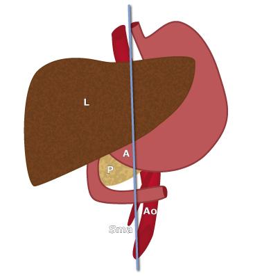 Ligne bleue : plan d’examen; A: antre; Ao: aorte; L: foie (liver); P: pancréas; Sma: artère mésentérique supérieure